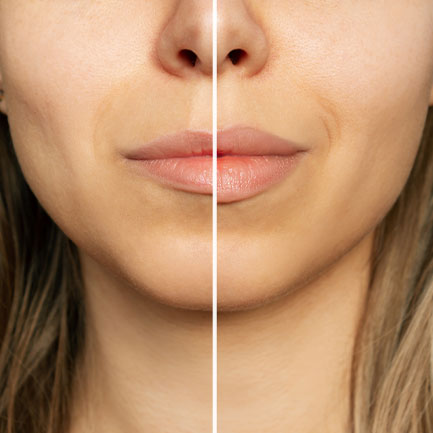 botox juvederm cheek lip fillers lakes region meredith nh